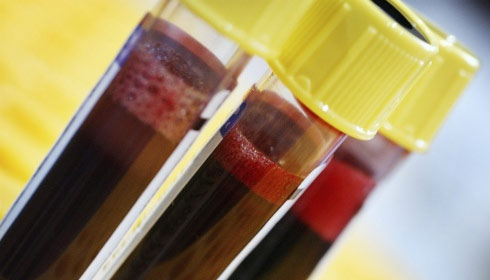 клинический анализ крови